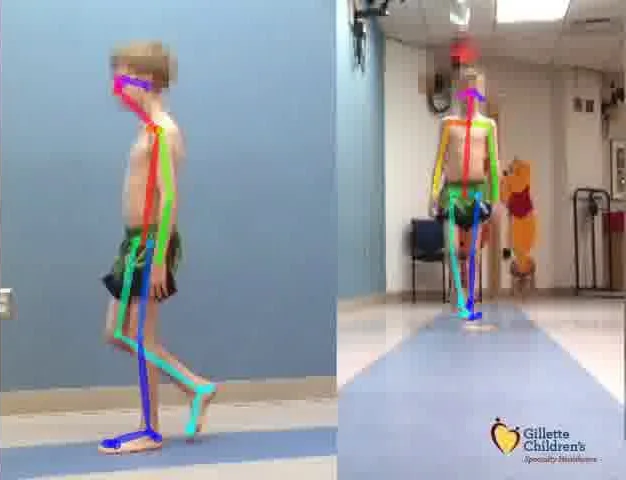 Video frames with anatomical landmarks overlaid for gait analysis